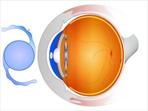 INTRAOCULAR LENSE illustration